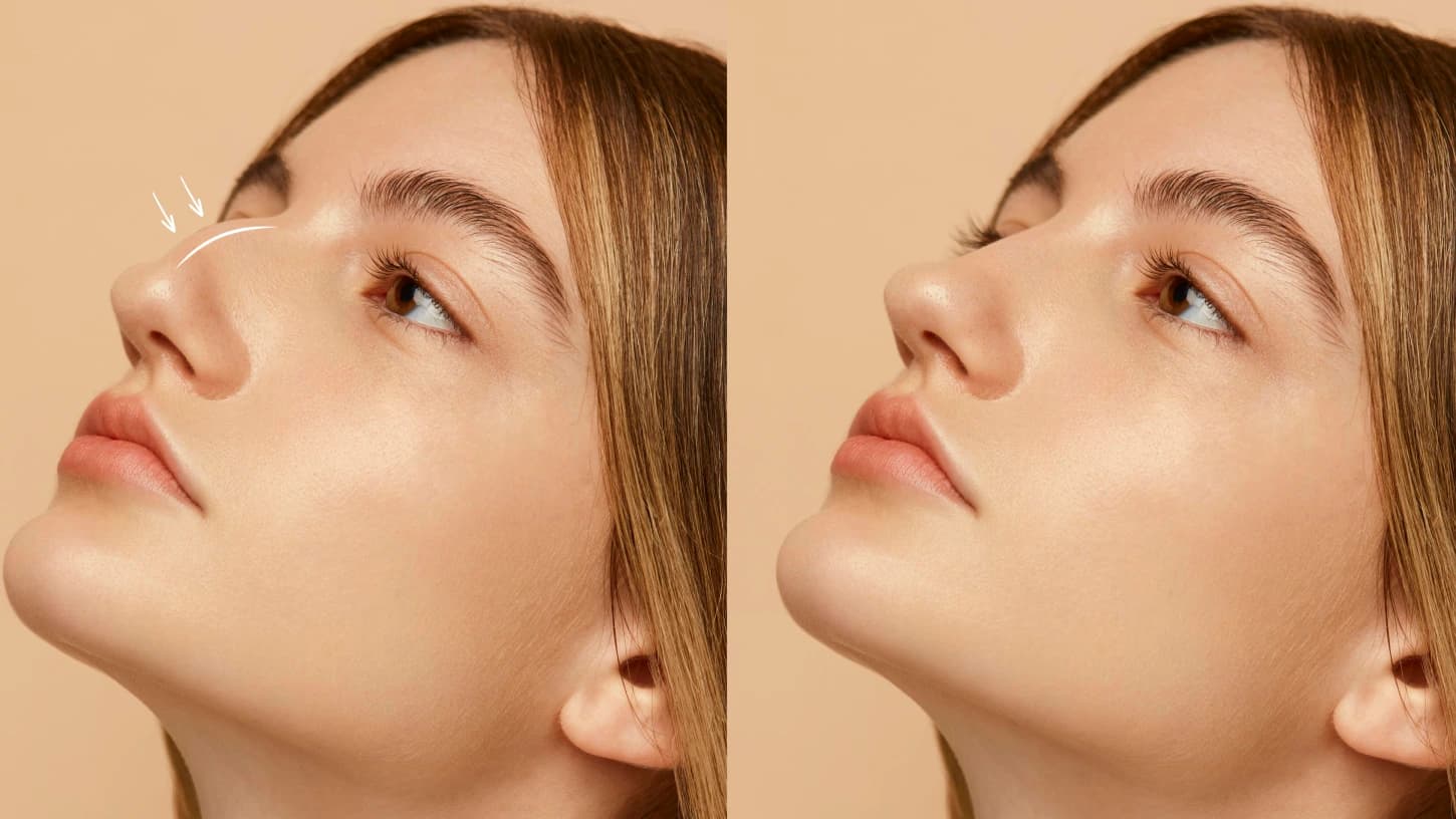 Rinoplasti (Burun Estetiği) Antalya